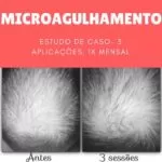 Microagulhamento capilar em Lajeado – Antes e Depois