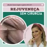 Blefaroplastia sem corte com eletrocautério e jato de plasma