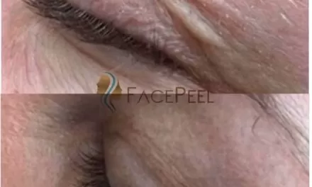 Blefaroplastia sem corte em lajeado/rs